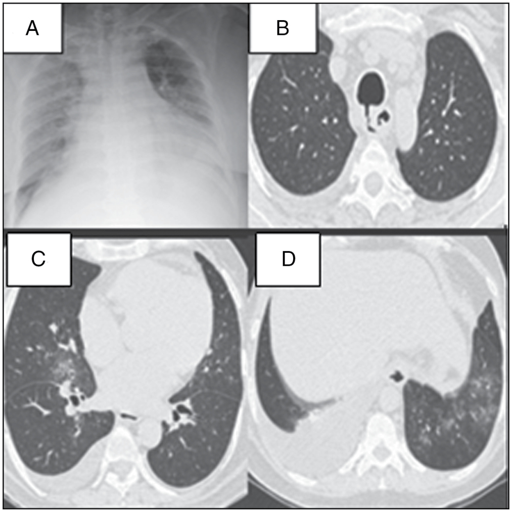 (a) Chest X-ray on admission-AP film right lung diffuse haziness apparent cardiomegaly. (b-d): HRCT plain: Middle lobe, left LL patchy infiltrates with right pleural effusion, and TOF