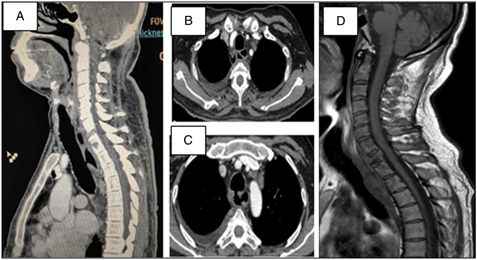 (a-c): CECT thorax: Relatively well-defined peripherally enhancing cavitatory soft tissue inflammatory mass in paraesophageal and prevertebral location communicating with trachea and esophagus with tracheoesophageal fistula formation and asymmetrical circumferential thickening involving the adjacent esophagus. (d) MRI spine showing prevertebral abscess with destruction of D2-D3 vertebrae