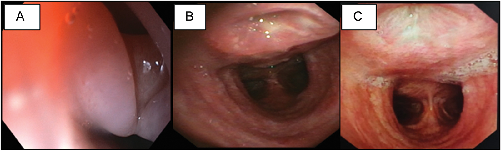 (a) Upper GI endoscopy showing fistulous track in anterior esophagus with smooth margins. (b) Bronchoscopy showing fistula in posterior tracheal wall at the time of diagnosis. (c) Bronchoscopy after 3 months showing healing of the fistula