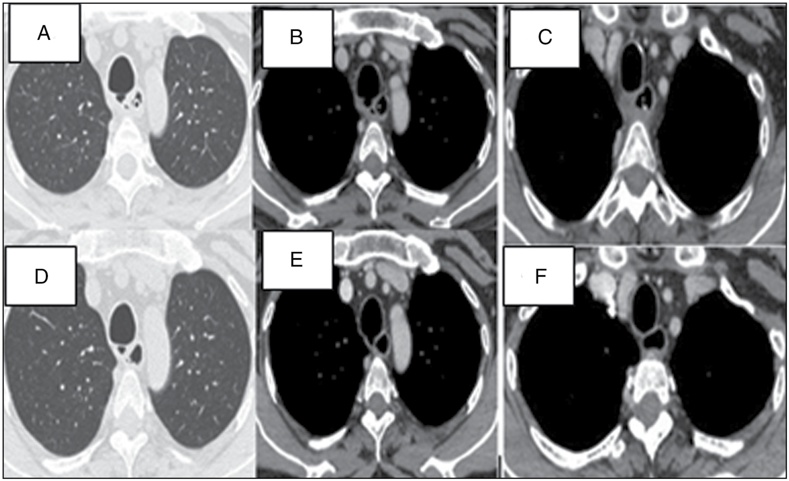 (a-c) CECT after 3 months and (d-f) CECT after 1 year of starting ATT, showing posterior tracheal wall diverticulum and progressive clearing of mediastinal soft tissue cavitation