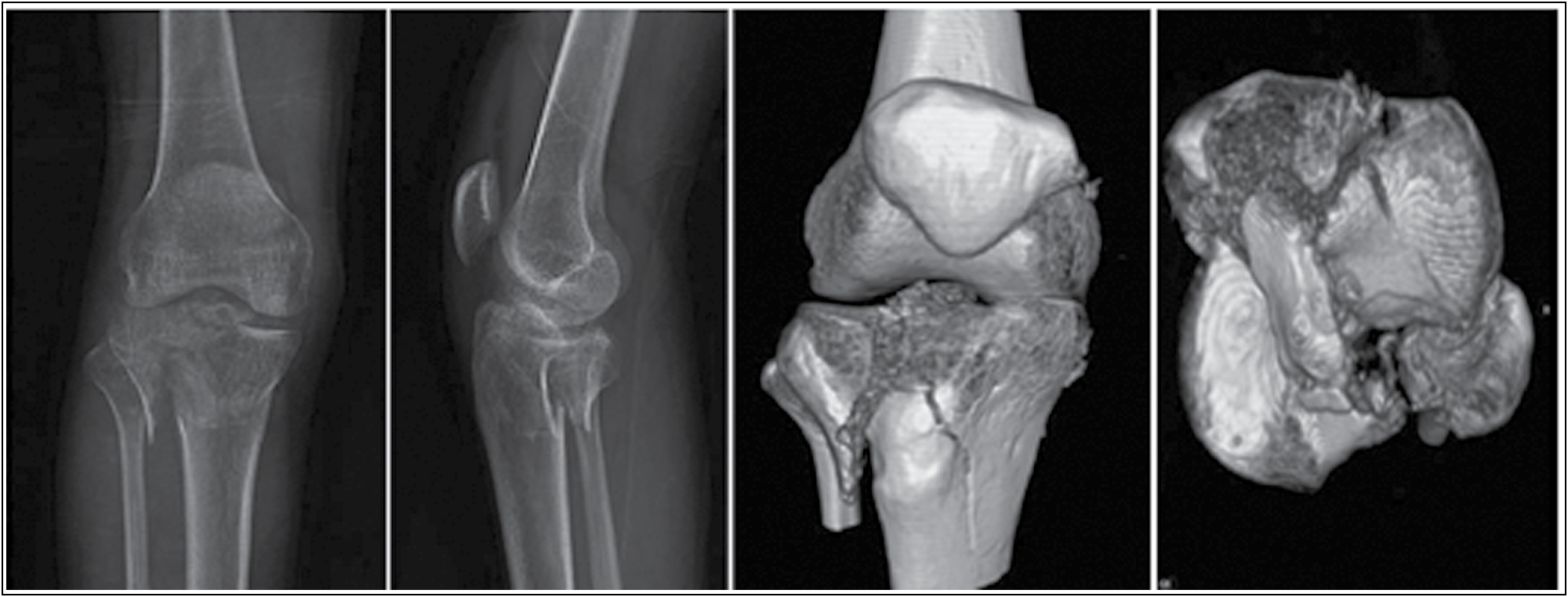 Preoperative radiographs (X-rays and CT)