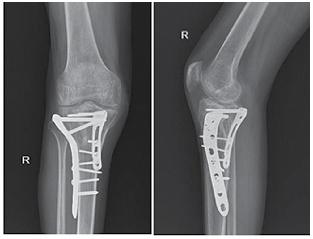 Postoperative radiographs at 6 month