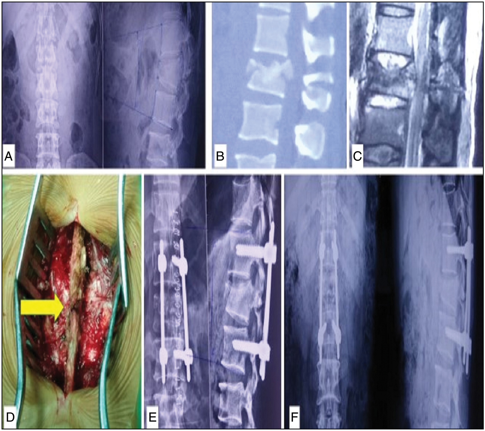 SSF for AO type B1 fracture. (a) Preoperative x-ray and (b) CT scan images showing the fracture line through L1 vertebral body and its spinous process, (c) MRI scan and (d) intraoperative images showing posterior ligamentous complex (PLC) injury, (e) immediate and (f) final follow-up postoperative x-rays showing in situ pedicle screw-rod construct