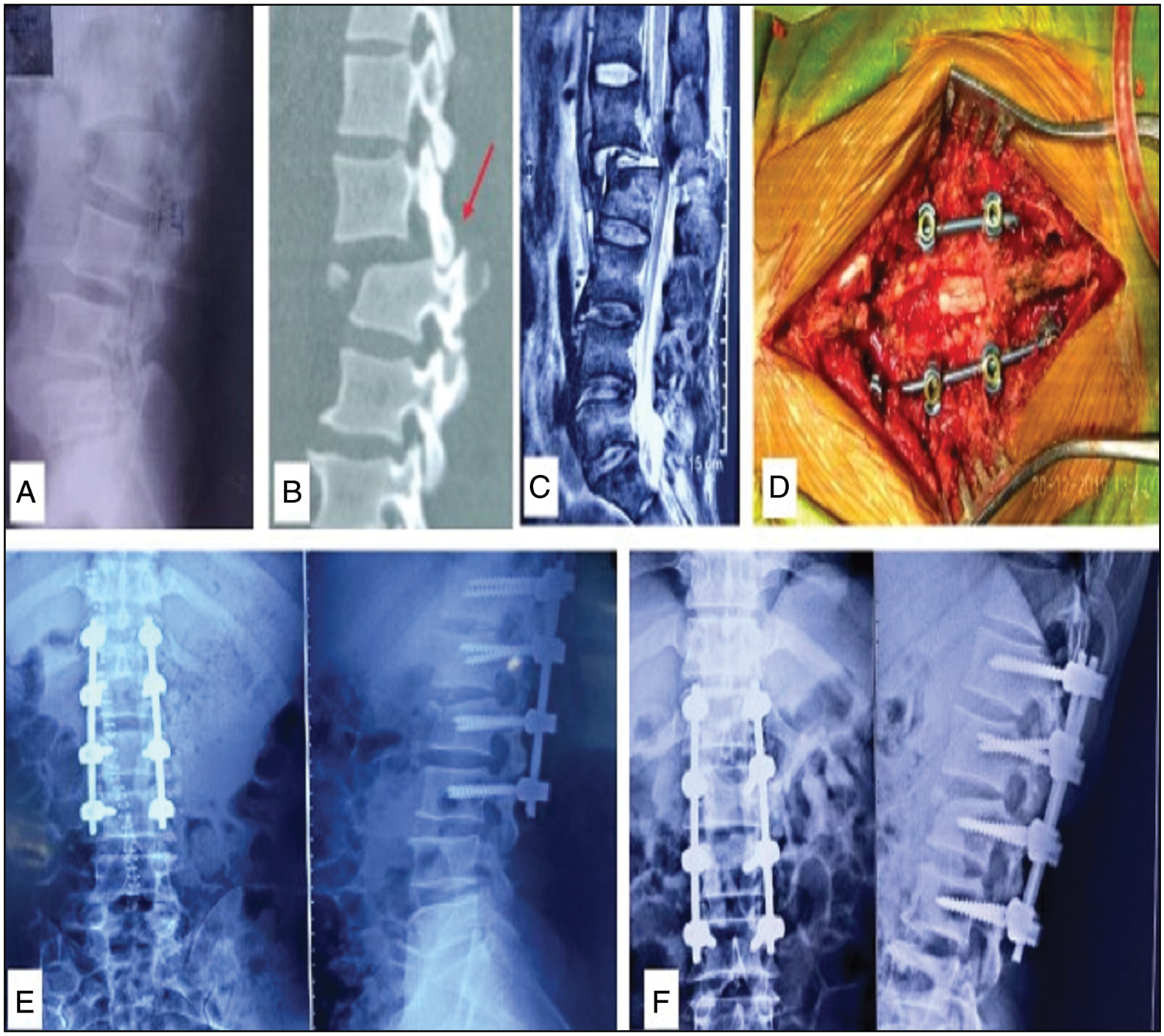 LSF for AO type C fracture. (a) Preoperative x-ray and (b) CT scan images showing anteriorly translated L1 over L2 with locked dislocated facet, (c) MRI image showing severe canal stenosis between L1 and L2 with injured posterior ligamentous complex (PLC), (d) intraoperative image showing spinal canal decompression by laminectomy with in situ screw-rod construct, (e) immediate postop, and (f) final follow-up x-rays