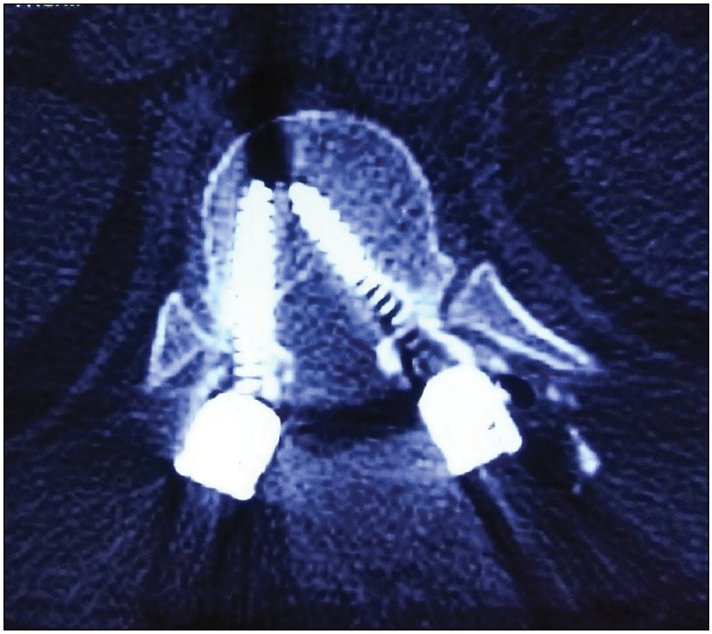 Axial CT image showing breach in medial cortex of the left pedicle