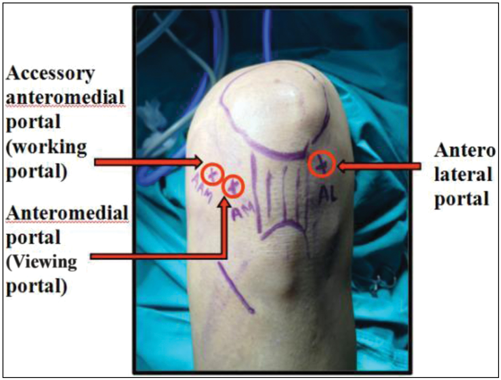 Standard triportals (anterolateral, accessory anteromedial, and anteromedial)