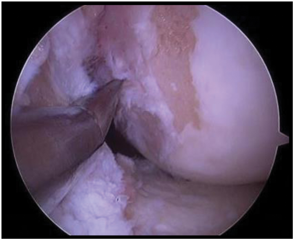 Visualization of anatomical femoral ACL insertion on the medial surface of lateral femoral condyle and the creation of femoral tunnel posterior to lateral bifurcating ridge with the help of microfracture awl inserting through accessory anteromedial portal