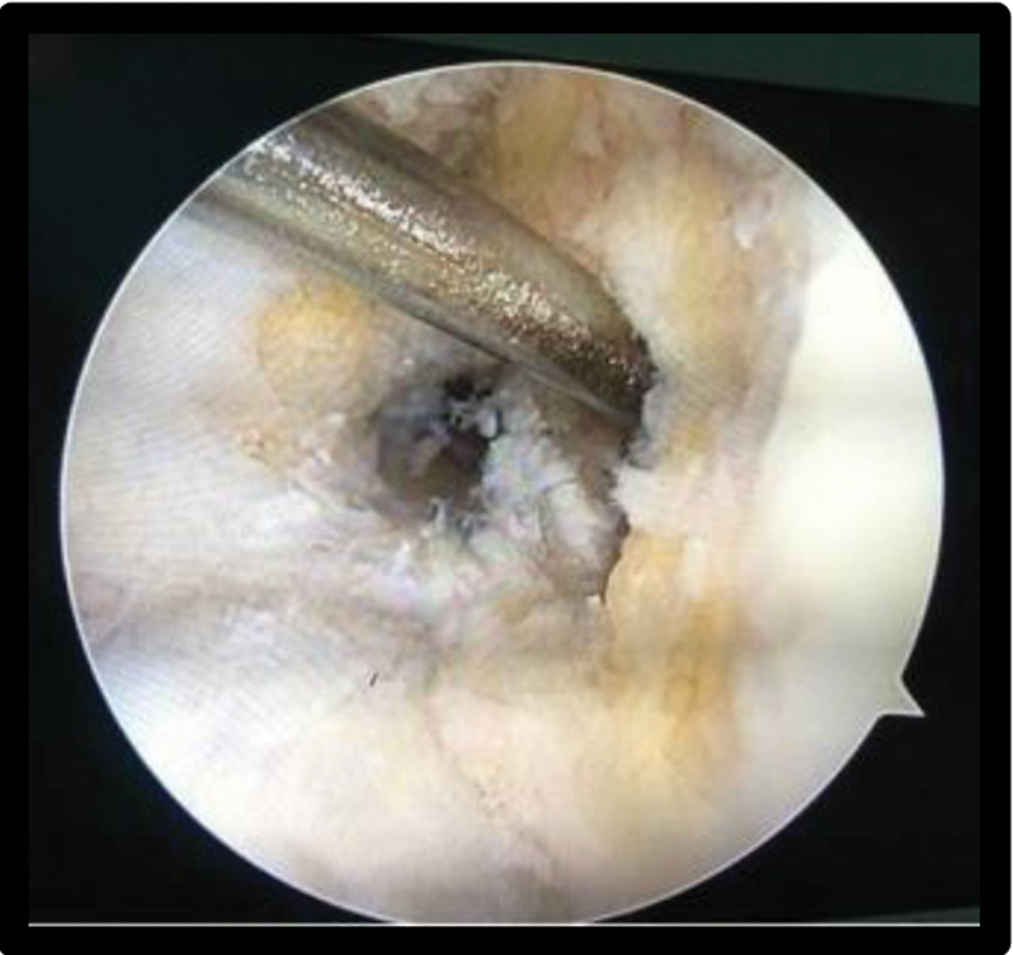 Intraoperative (arthroscopy) picture of the same