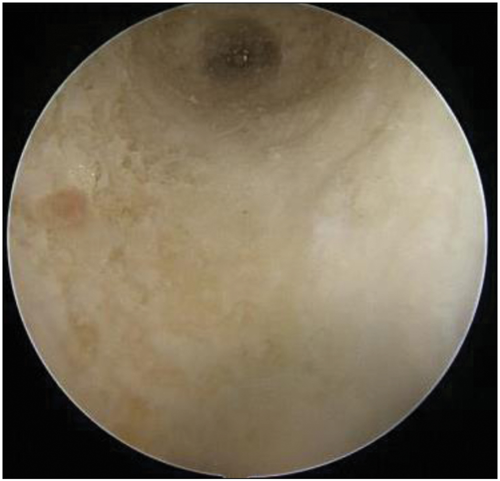 Intact lateral femoral cortex visualized through the accessory anteromedial portal