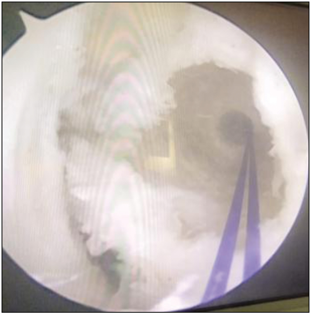 Arthroscopic visualization of the femoral insertion after reaming from the accessory anteromedial portal