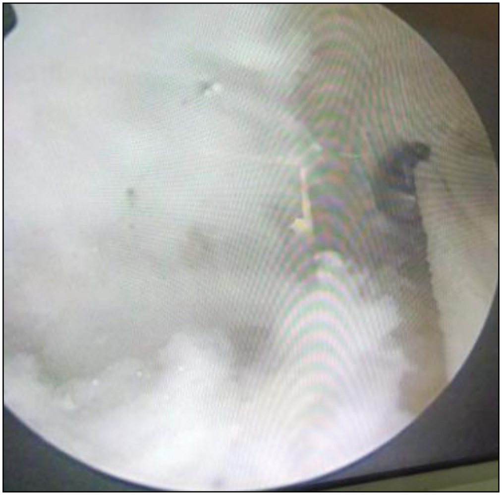 View from the anteromedial portal of the suspensory fixation