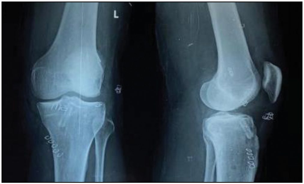 Postoperative x-ray showing the tunnel position