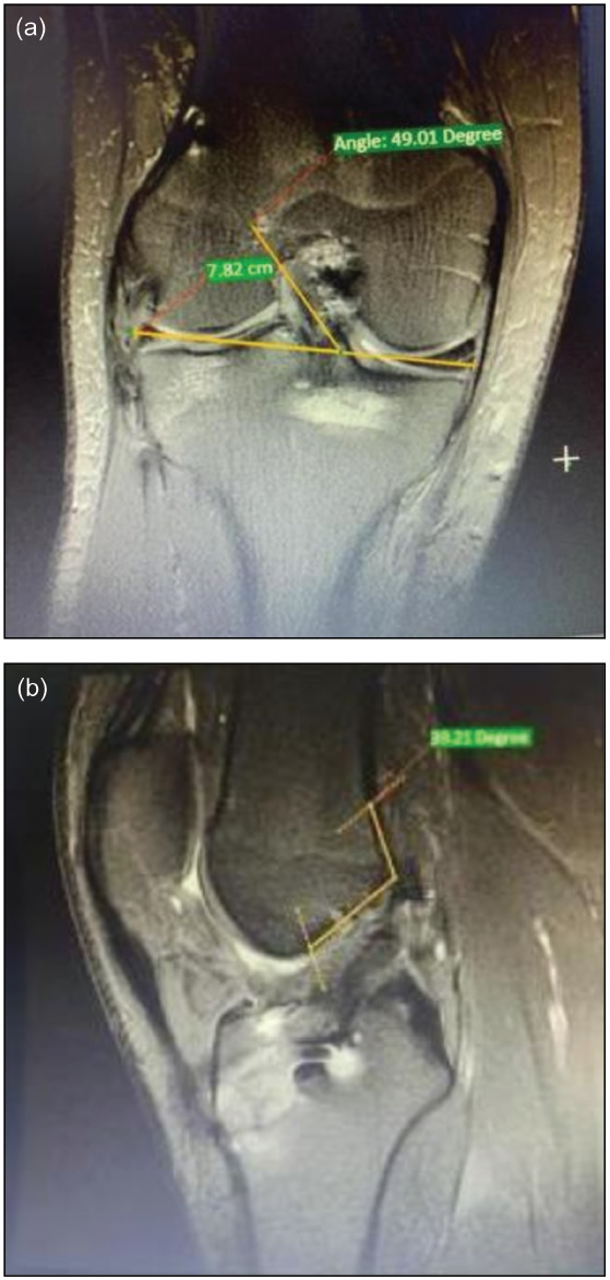 Calculation of the inclination of the graft in (a) coronal and (b) saggital plane