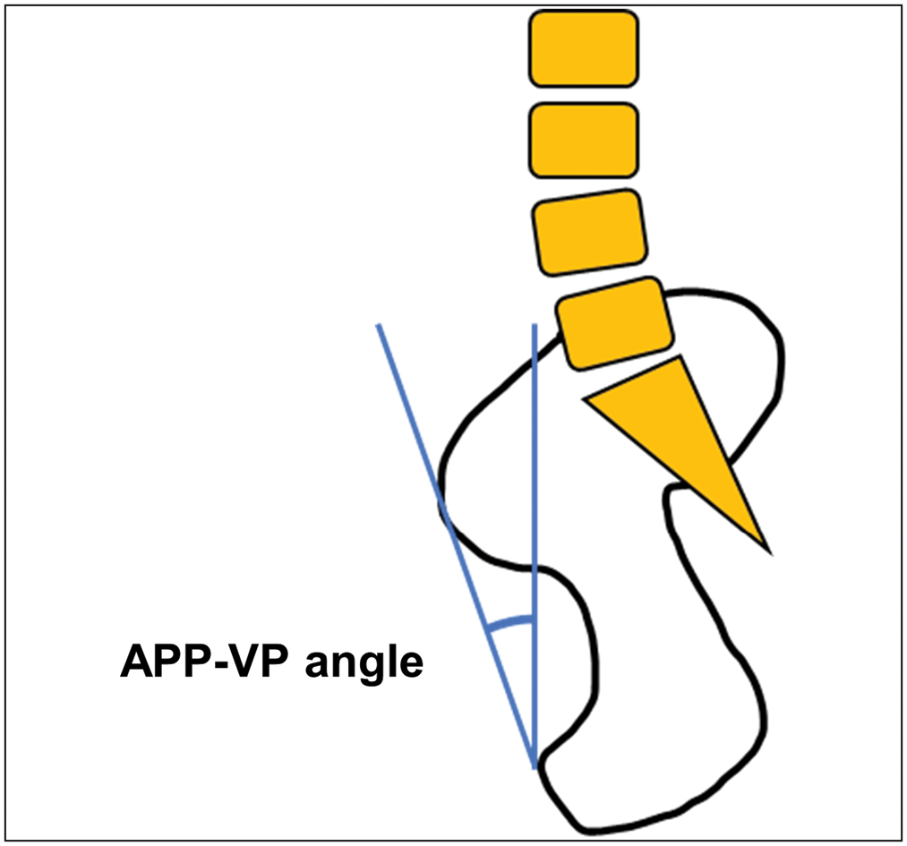 APP-VP angle was measured between a line drawn from the anterior superior iliac spines to the pubic symphysis and the vertical line