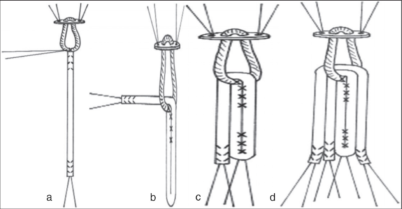 (a–d) Preparation of 5-strand hamstring graft