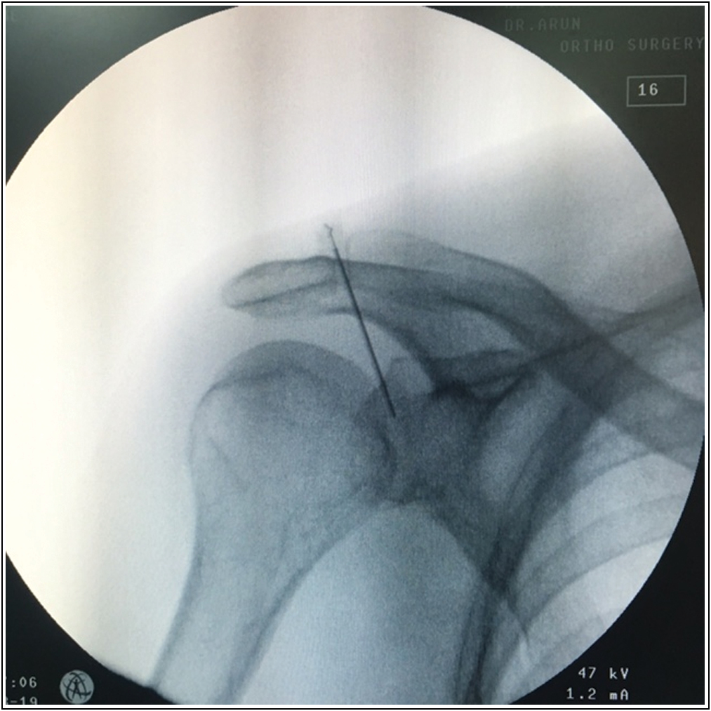 Intra articular injection of platelet-rich plasma.