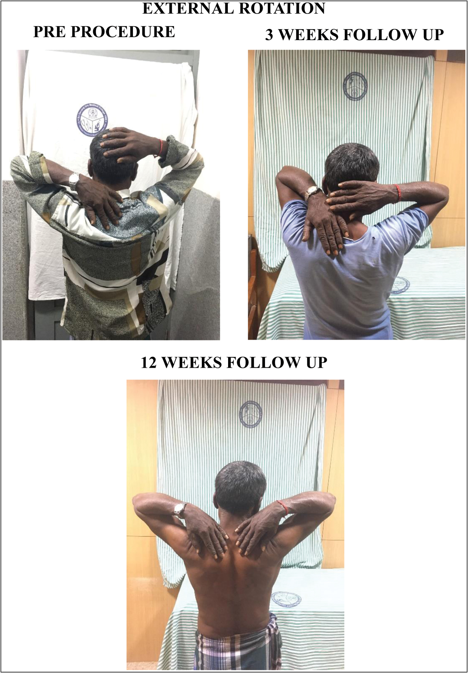 Internal rotation: pre-procedure, 3-week follow-up, and 12-week follow-up