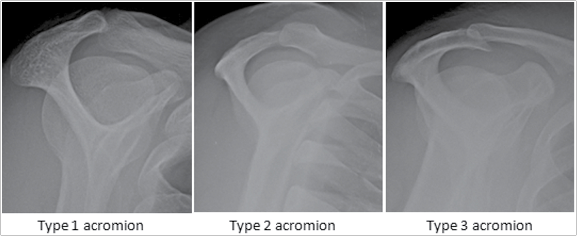 Three types of acromion X-ray image: (1) type 1––flat, (2) type 2––curved, and (3) type 3––hooked