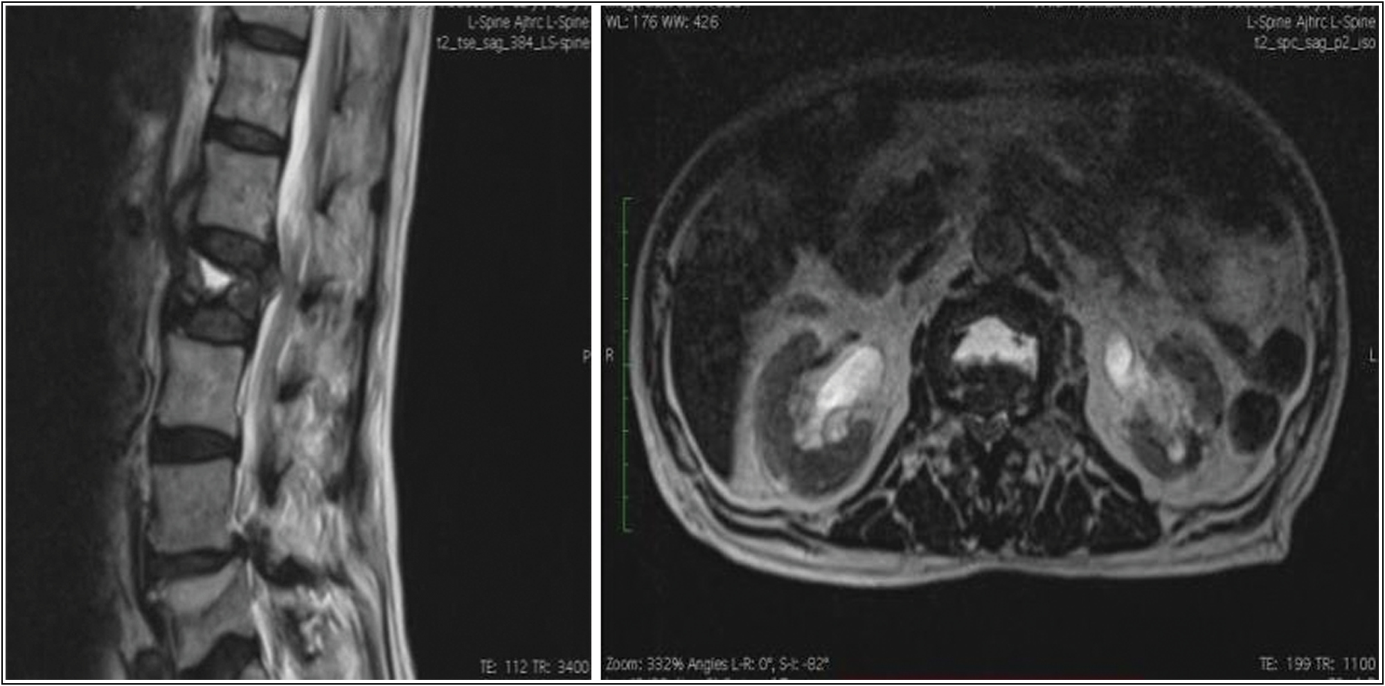 “Fluid sign” seen in L2 vertebra on T2 weighted MRI images