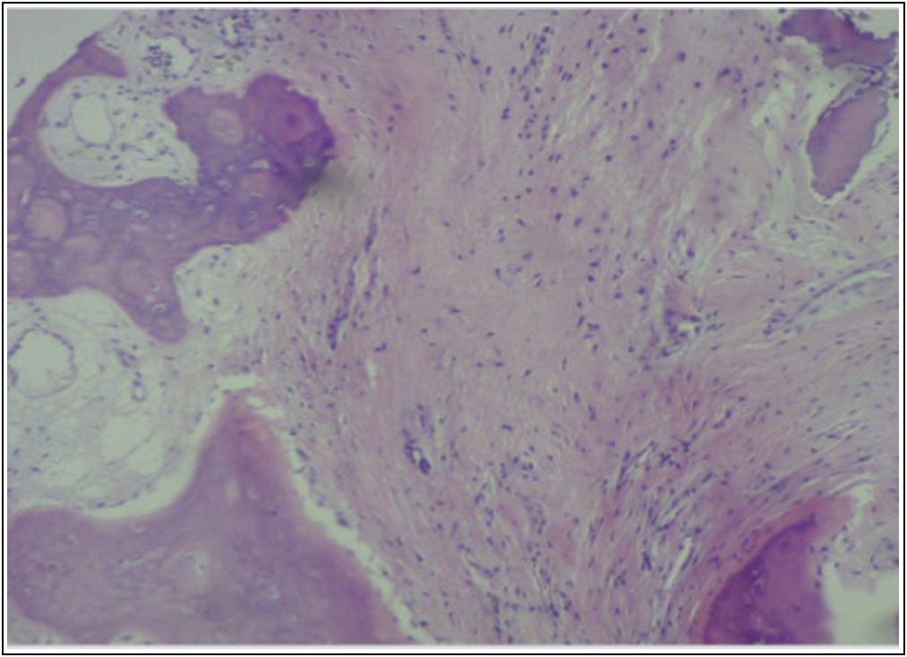 Bony trabeculae seen with foci showing sample being collected of fibrosis on histopathology from L2 vertebra