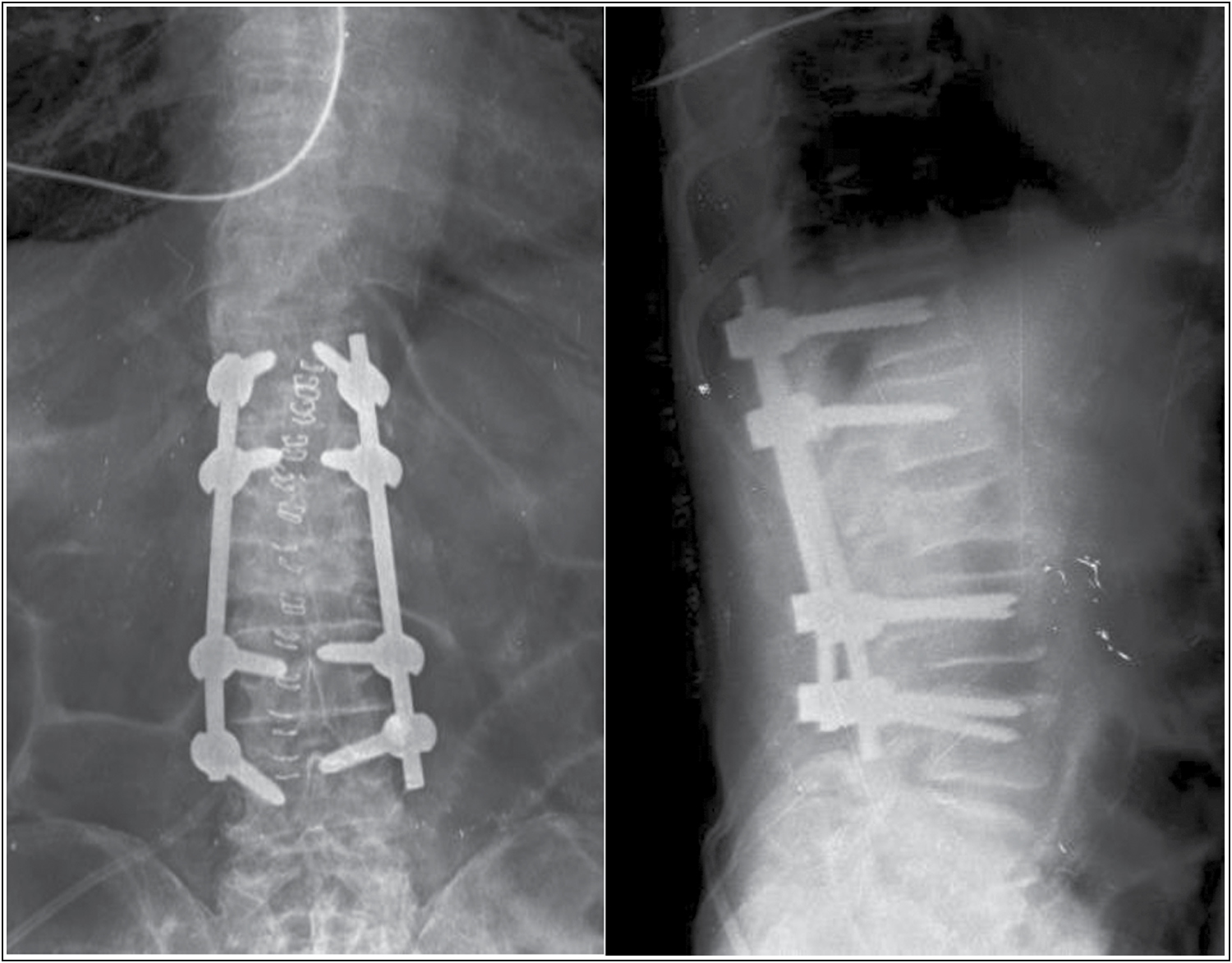 Restored height of L2 vertebra, following T12-L4 posterior instrumented stabilization