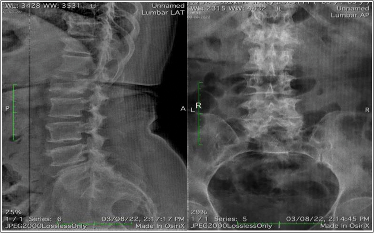 AP and lateral radiograph showing L1 vertebra fracture with “vacuum cleft” inside body of L1 vertebra