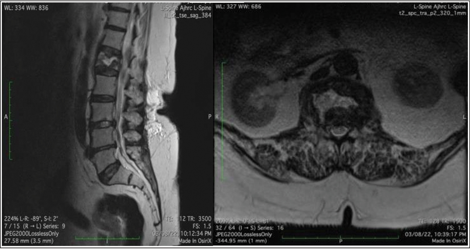 T2 weighted MRI showing “fluid sign” in L1 vertebra