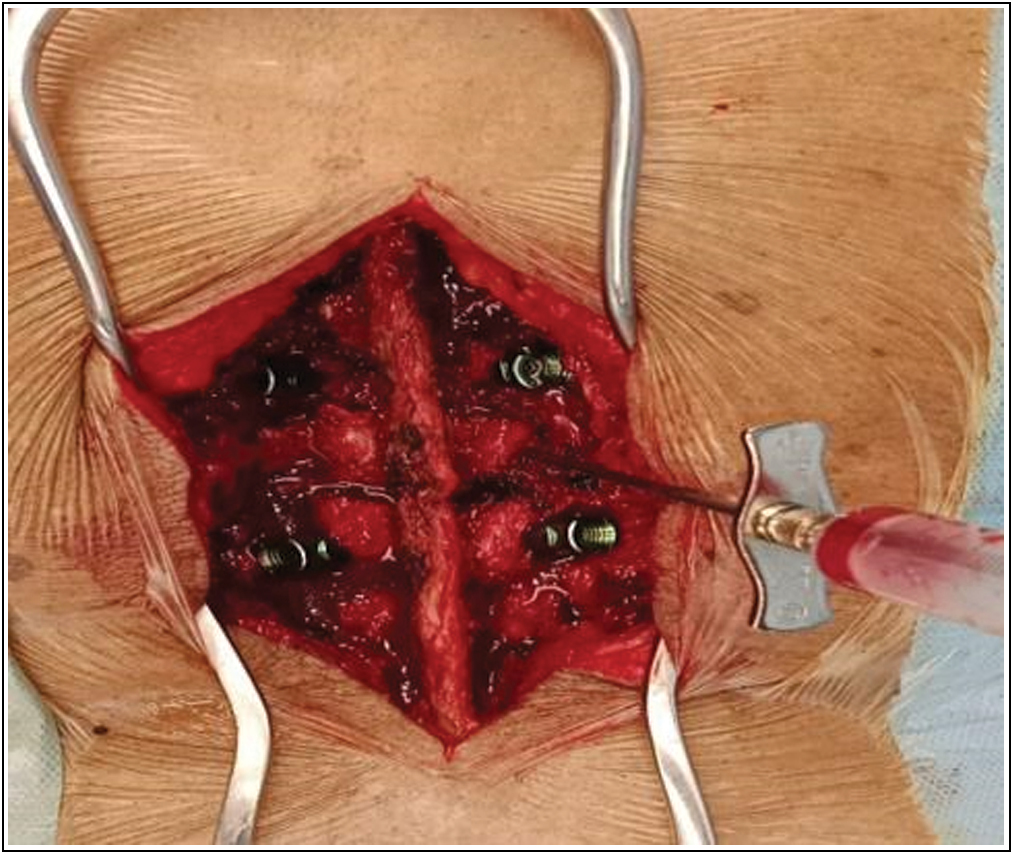 Intra-operative image showing aspiration of fluid from L1 vertebra