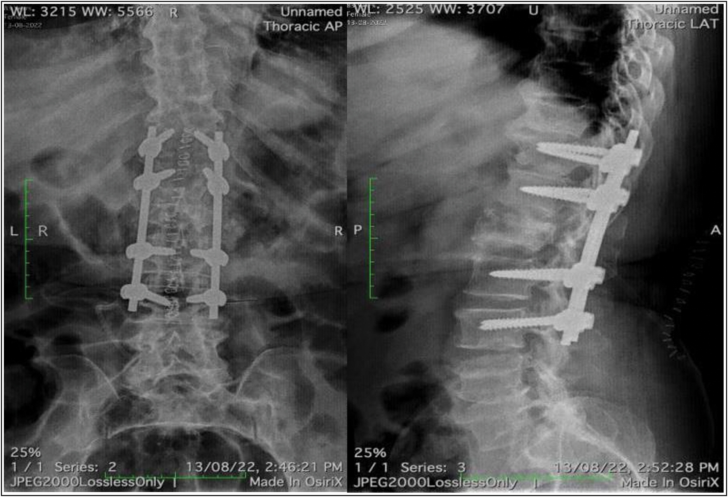 Post-operative radiograph after T11-L3 posterior instrumented stabilization