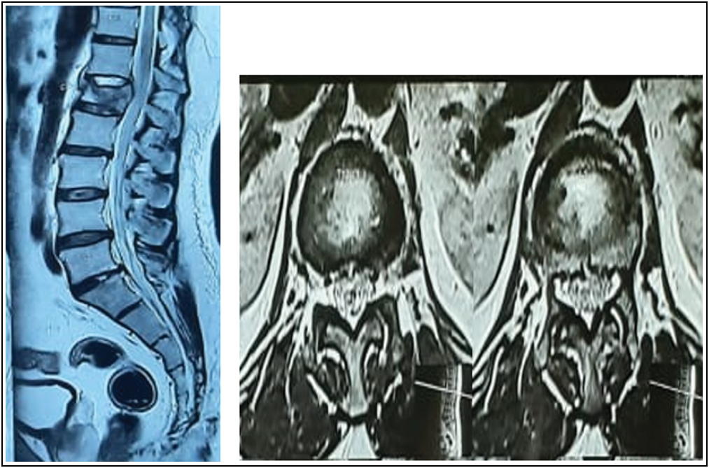 T2 weighted MRI images showing edema at L1 vertebra