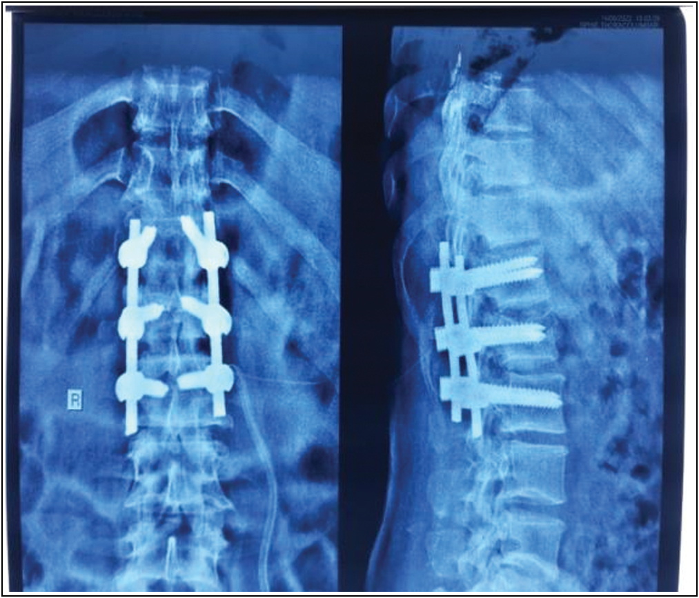 Radiograph showing T11-L3 posterior instrumented stabilization after 6 weeks follow-up