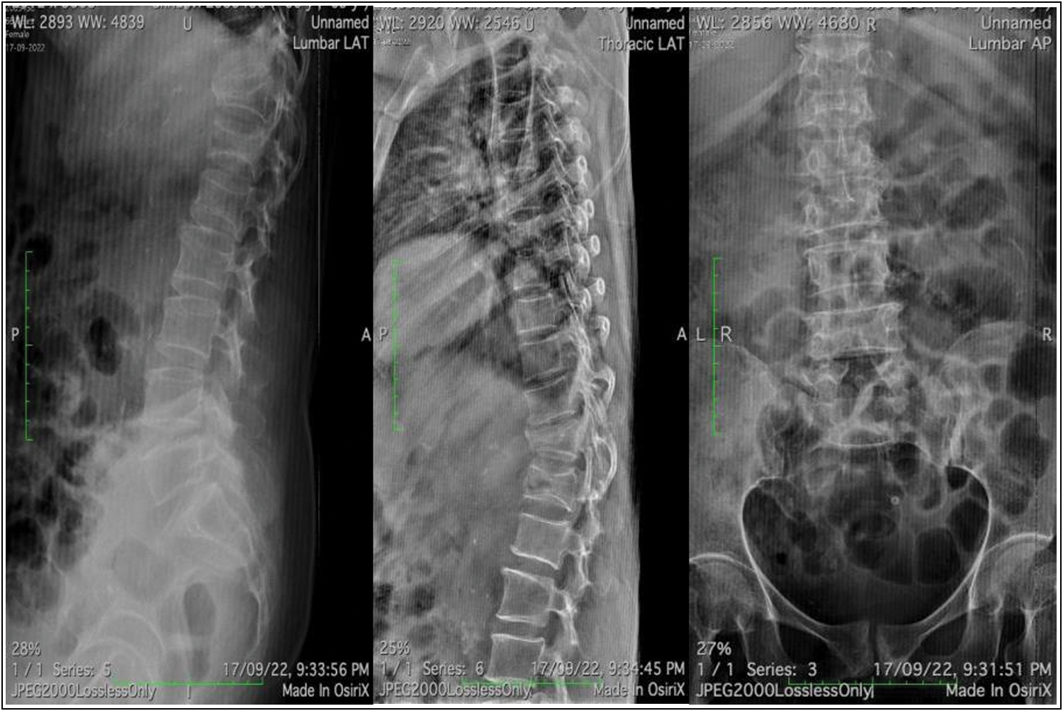 Plain radiographs showing fracture of D12 and L1 vertebra. “Vacuum cleft” sign visualized over L2 vertebra