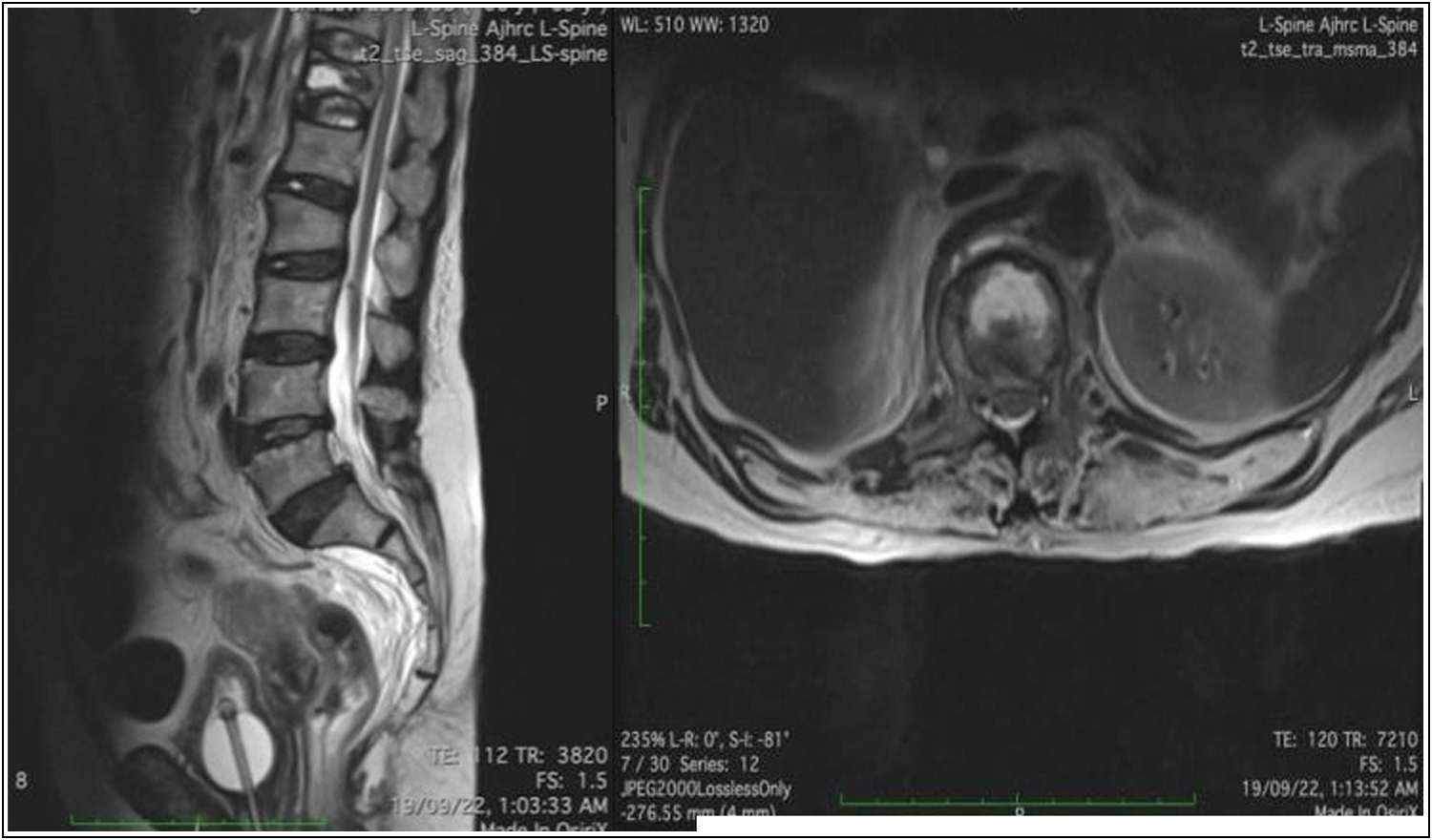 “Fluid sign” seen in L1 vertebra on T2 weighted MRI