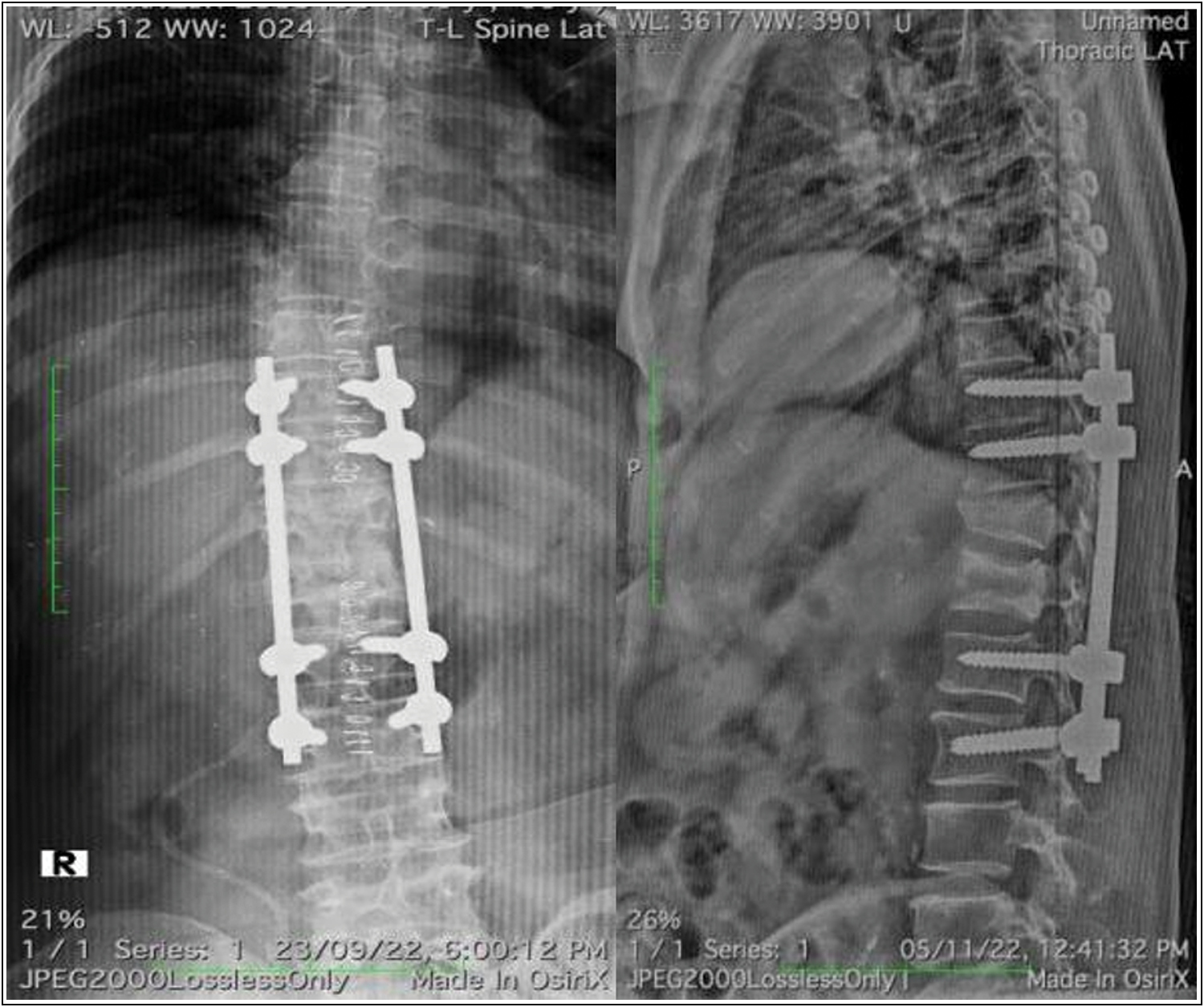 Post-operative radiograph after D10 to L3 posterior instrumented stabilization