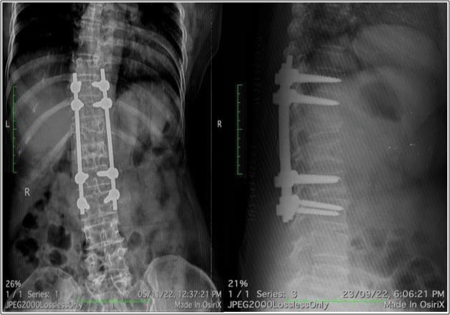 AP and lateral radiograph taken after 6 weeks of follow-up