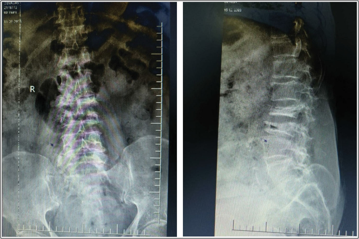 AP and lateral radiograph showing L2 and L3 compression fracture