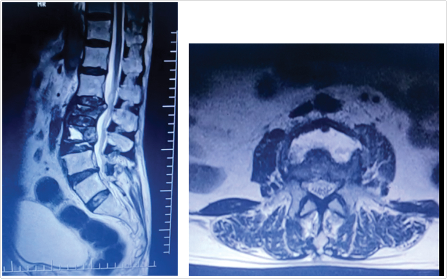 “Fluid sign” noted over L3 vertebra on T2 weighted MRI