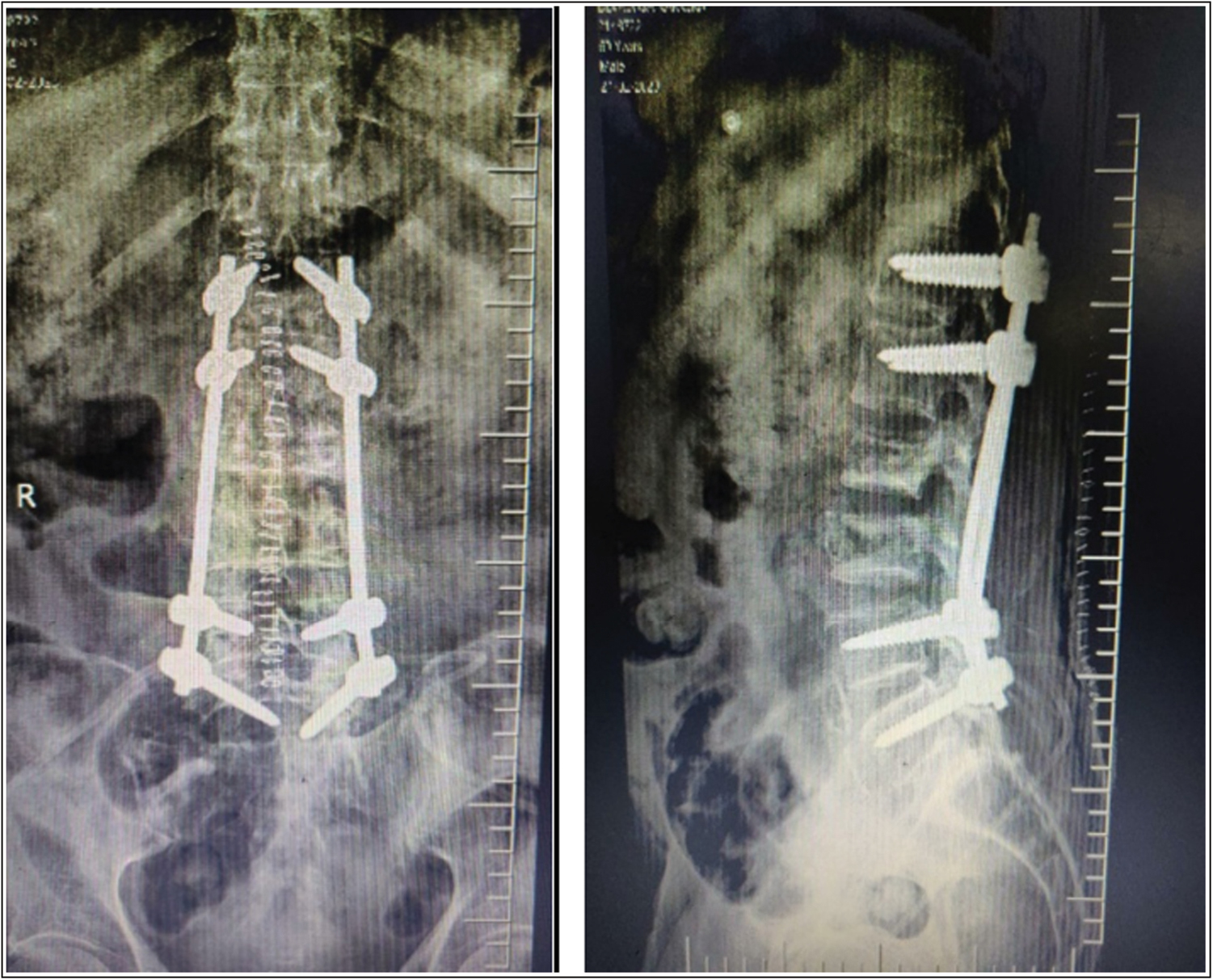 T12 to L5 posterior instrumented stabilization