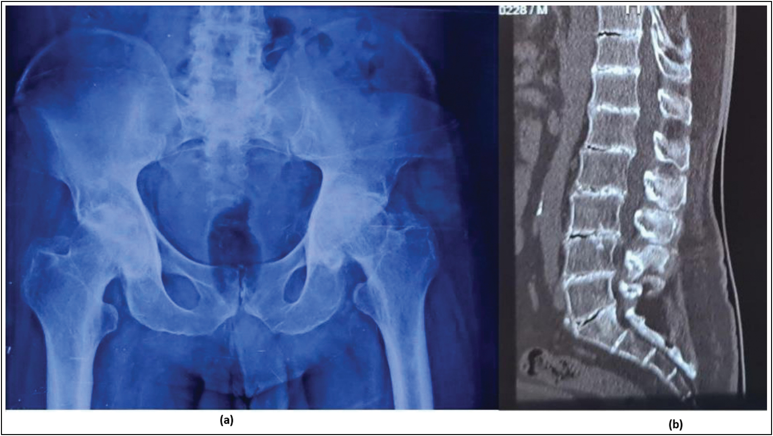 Case II - (a) Plain radiograph of Pelvis with both hips demonstrating reduction in joint space of both hips with subchondral cysts in both femoral head and sclerosis of acetabular wall (Ficat and Arlet Stage IV). (b) CT scan of Lumbosacral spine shows Vacuum phenomenon (accumulation of air/gas in intervertebral disc spaces) and Schmorl's nodes indicating the degenerative nature of this disorder