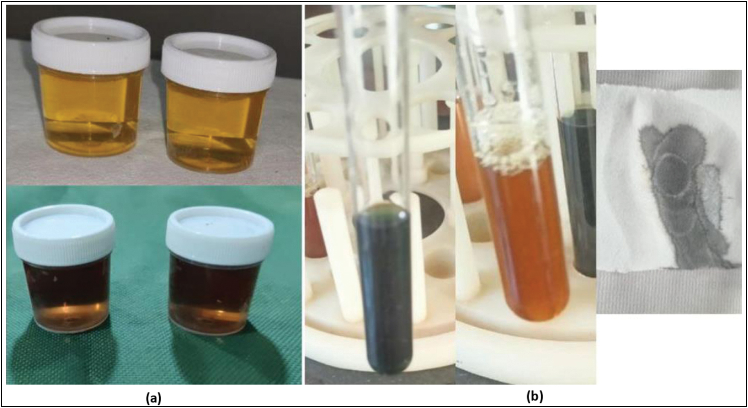 Simple reliable tests to detect Alkaptonuria. (a) The most simple and economical test is the classical darkening of urine on exposure to air/sunlight due ton oxidation of Homogentisate and its by-products. (b) Tests for reducing products like Ferric Chloride, benedict's test and Ammoniacal silver nitrate was positive due to the characteristic reducing nature of the urine.