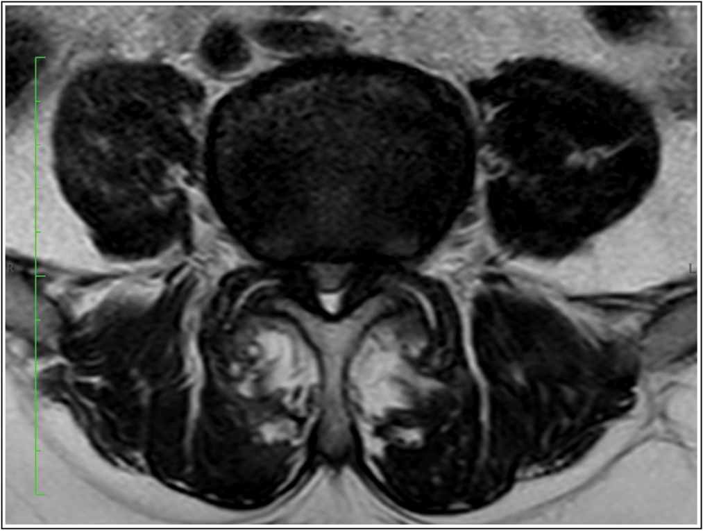 This clinical picture was associated with a painful symptomatology in the right hip due to coxarthrosis; an advanced state of arthrosis was clearly observable in a diagnostic radiograph. Source: Photo property of C. Capuano