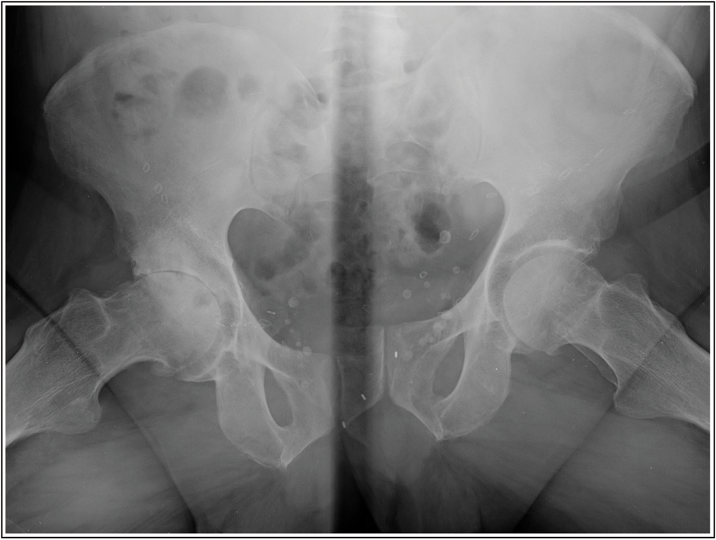 Presence of grade III coxarthrosis according to the Tonnis classification, clinically symptomatic with functional impotence to load and limitation of range of movement. Source: Photo property of C. Capuano