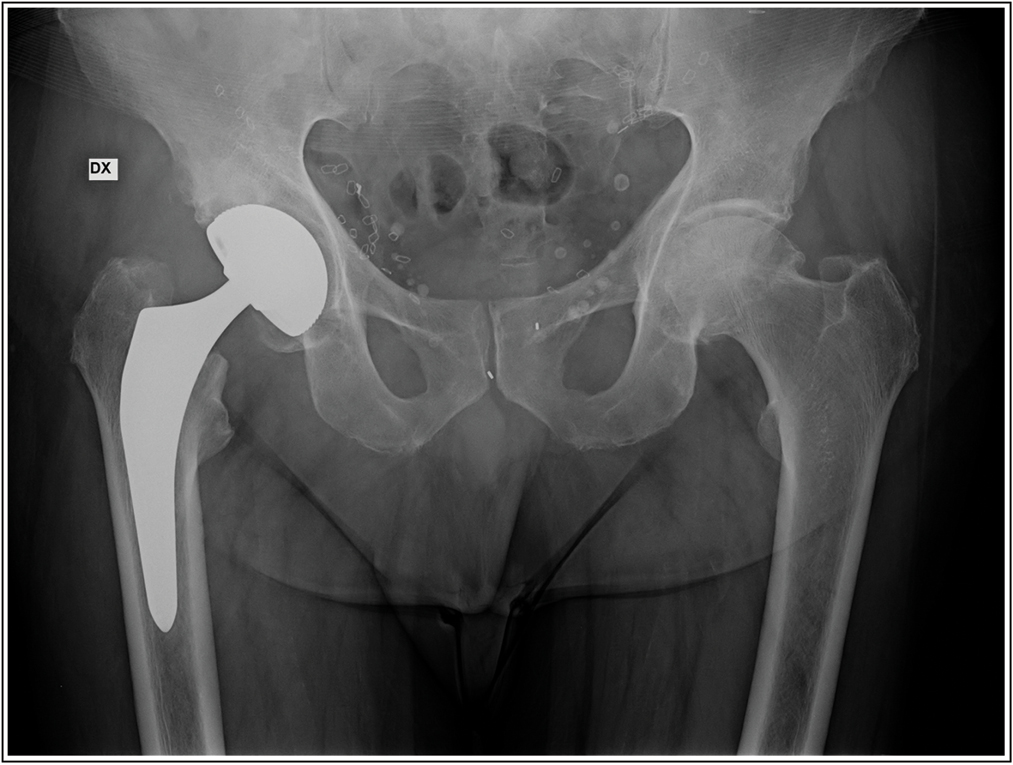 Postoperative X-ray shows lumbar arthrodesis with cage insertion with TLIF approach and total hip replacement. Source: Photo property of C. Capuano