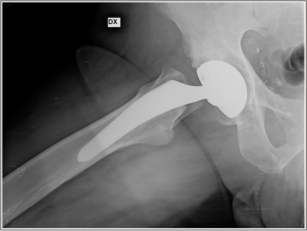 Post-operative X-ray shows Minimally invasive total hip arthroplasty using the anterior approach. Source: Photo property of C. Capuano