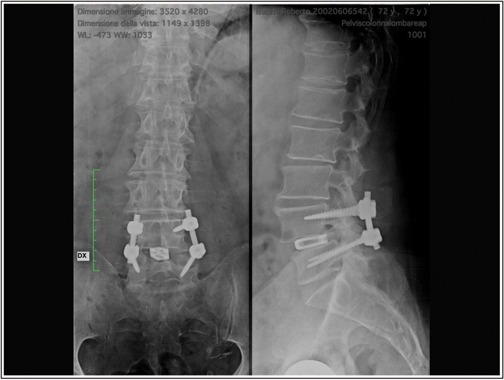 Post-operative X-ray anterior and lateral view: Lumbar Arthrodesis L4-L5 with mini-open Transforaminal lumbar interbody fusion (TLIF) procedure. Source: Photo property of C. Capuano