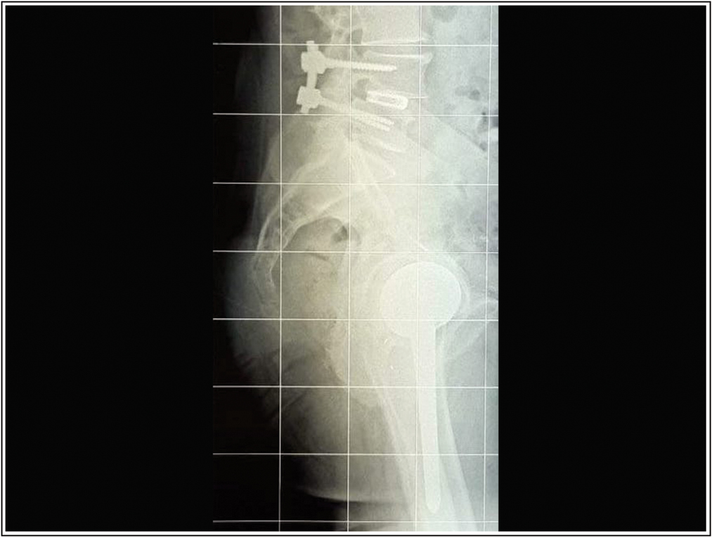 Post-operative X-ray shows Lumbar Arthrodesis L4-L5 with mini-open Transforaminal lumbar interbody fusion (TLIF) procedure and Minimally invasive total hip arthroplasty using the anterior approach. Source: Photo property of C. Capuano