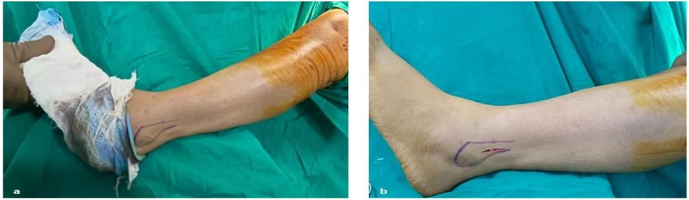 (a) Posterolateral side of the fibula with a longitudinal incision in the skin—solid line. (b) 2 cm proximal from the lateral malleolus’s posterior margin.