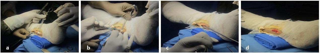 (a) Peroneus longus tendon (PLT) pulled out using mixter. (b) PLT incised 1 inch proximal to lateral malleolus after taking a whip stitch in distal end of PLT. (c) PLT harvested using tendon stripper. (d) Paroneal sheath is closed.