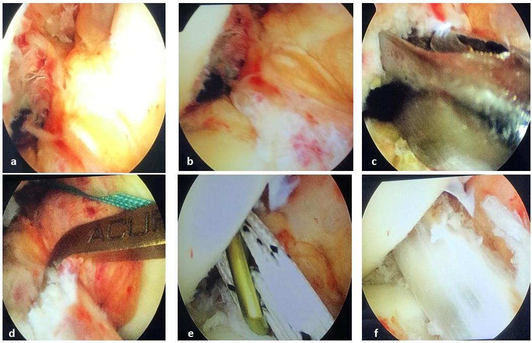 (a) Right knee intra-articular view showing torn anterior cruciate ligament. (b) Empty notch sign. (c) Transportal femoral tunnel made using 7 mm offset aimer. (d) Tibial entry made at anatomical point. (e) Graft pulled along with the loop. (f) Graft passed in femoral tunnel and fixed with endobutton on femoral side.