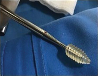 Tibial side fixation done using bioabsorbable screw.